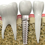 Dental Implants, Austin Heights Dental Centre, Coquitlam Dentist